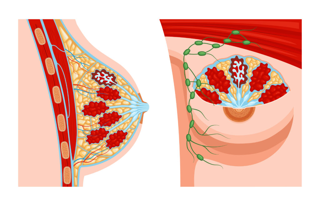 Breast Lumps