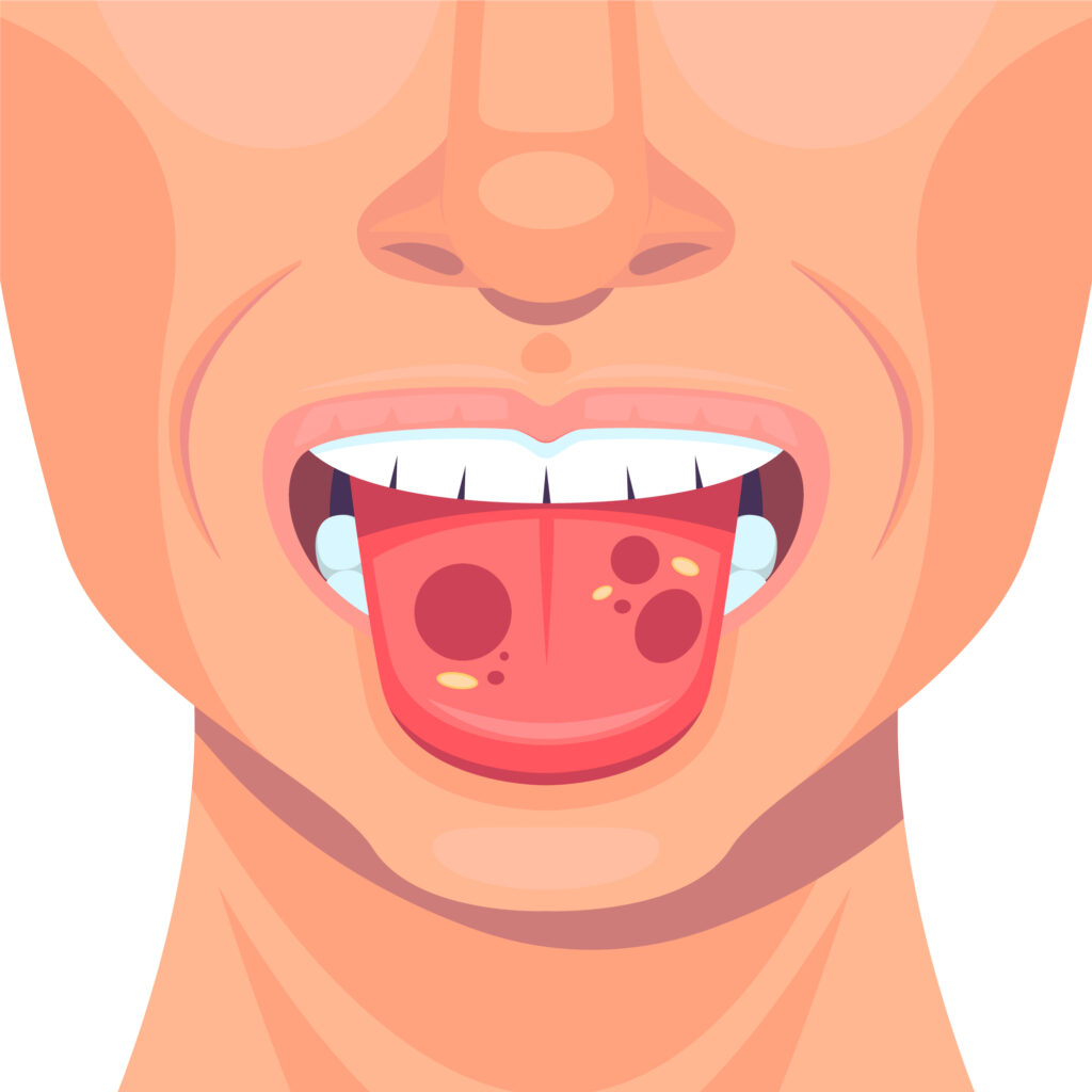 Oral & Tongue Lesions