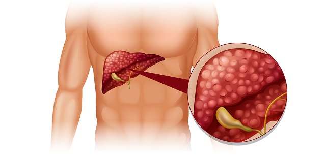 Pancreatic & Liver Masses