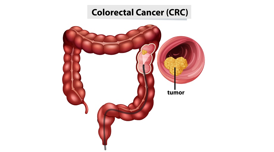 Colorectal Cancer