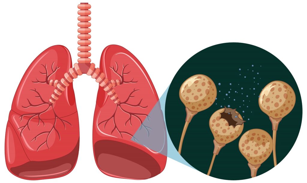 Lung cysts