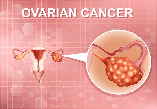 Ovarian & Uterine Tumors