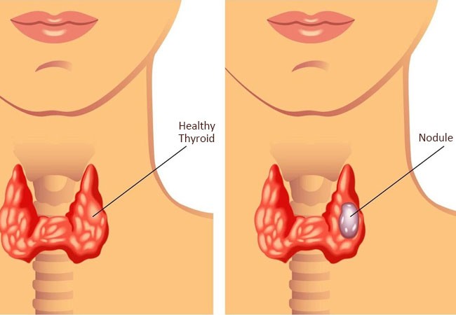 thyroid-nodule