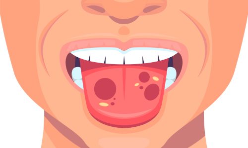 Oral & Tongue Lesions: Causes, Care, and When to See a Doctor