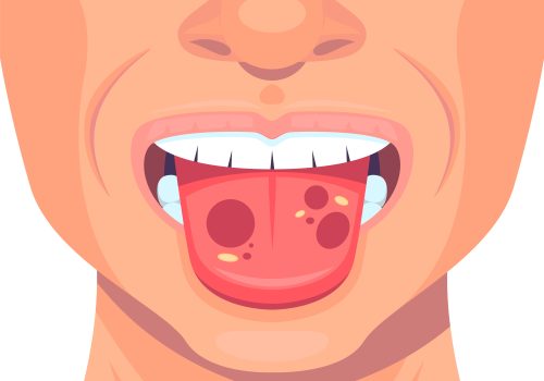 Oral & Tongue Lesions: Causes, Care, and When to See a Doctor
