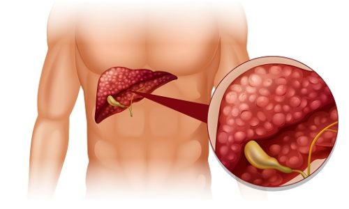 Pancreatic & Liver Masses: Causes, Cancer Risk & When to Seek Medical Advice