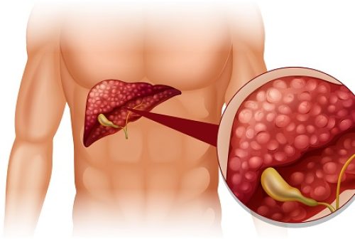 Pancreatic & Liver Masses: Causes, Cancer Risk & When to Seek Medical Advice