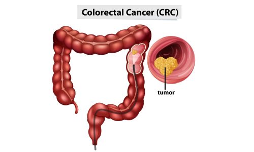 Colon & Rectal Growths: Polyps, Cancer Risk & When to Take Action