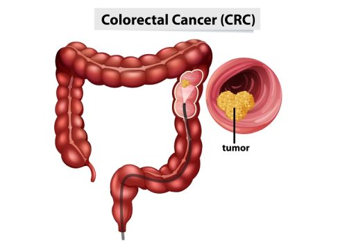 Colon & Rectal Growths: Polyps, Cancer Risk & When to Take Action