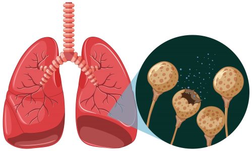 Lung & Chest Masses: Causes, Cancer Warning Signs & When to Seek Help