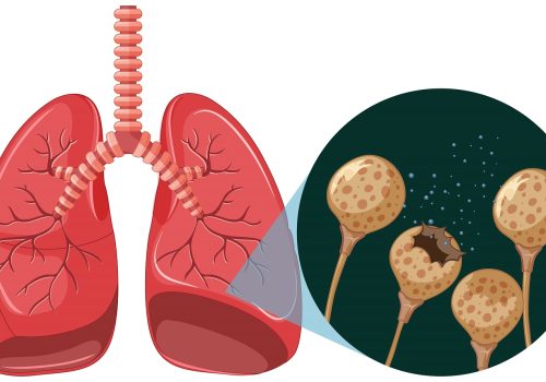 Lung & Chest Masses: Causes, Cancer Warning Signs & When to Seek Help