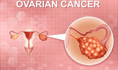 Ovarian & Uterine Tumors: Know the Signs, Risks & When to Seek Help