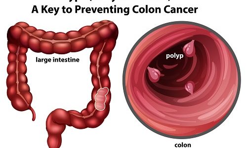 Illustration of colon polyps and large intestine