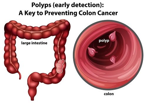 Illustration of colon polyps and large intestine