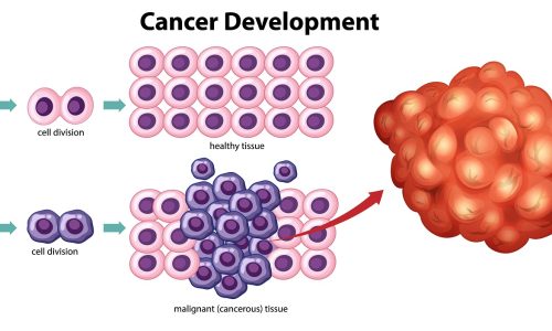 Prostate Enlargement/Tumors: Understanding Growths in the Body & When to Take Action