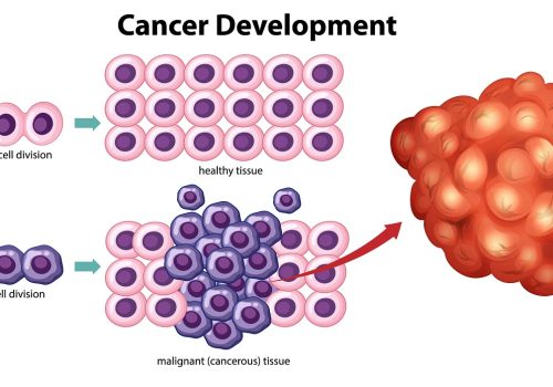 Prostate Enlargement/Tumors: Understanding Growths in the Body & When to Take Action