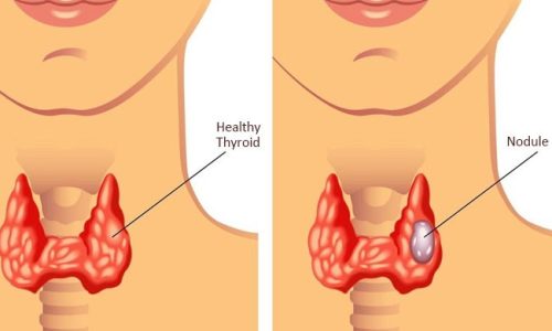Thyroid Nodules Explained: Causes, Cancer Risk & When to Worry