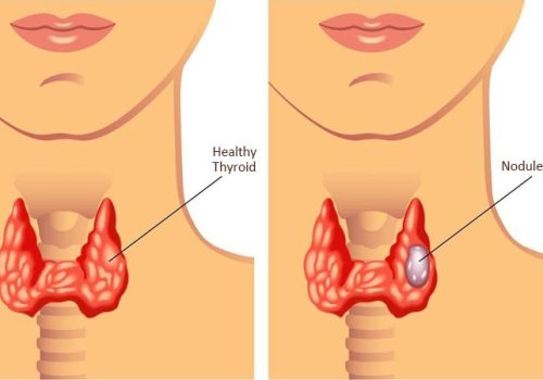 Thyroid Nodules Explained: Causes, Cancer Risk & When to Worry